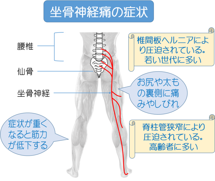 坐骨神経痛の症状 お尻や太ももの裏側に痛みと痺れ 筋力の低下